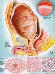 Thickening of the bladder wall muscle occurs in response to obstruction.